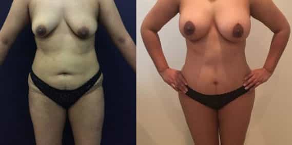 Before and after Mommy Makeover Colombia - Premium Care Plastic Surgery