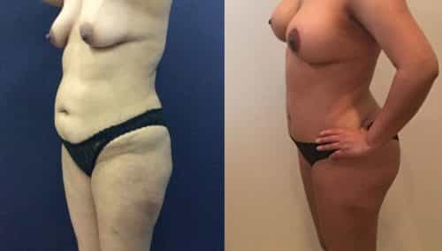 Before and after Mommy Makeover Colombia - Premium Care Plastic Surgery