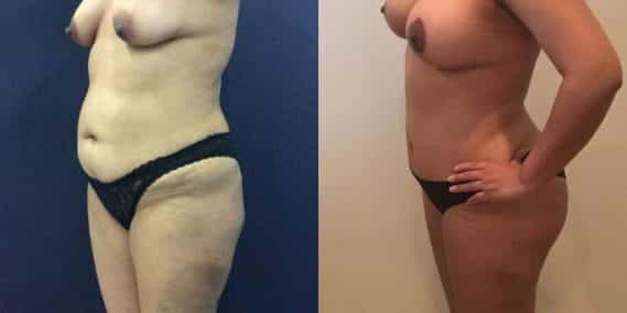 Before and after Mommy Makeover Colombia - Premium Care Plastic Surgery
