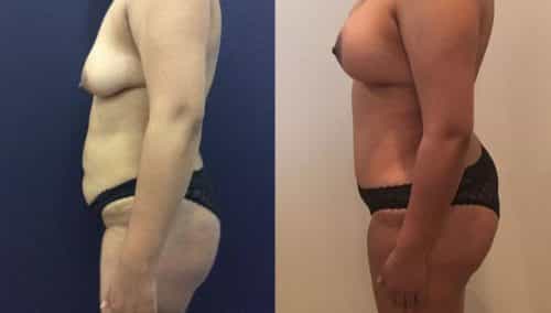 Before and after Mommy Makeover Colombia - Premium Care Plastic Surgery