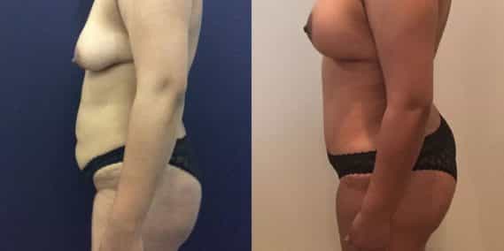 Before and after Mommy Makeover Colombia - Premium Care Plastic Surgery