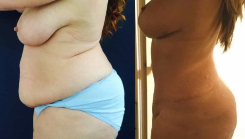 Before and after Mommy Makeover Colombia - Premium Care Plastic Surgery