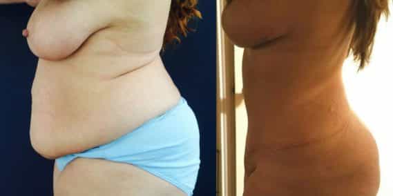 Before and after Mommy Makeover Colombia - Premium Care Plastic Surgery