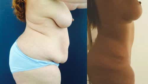 Before and after Mommy Makeover Colombia - Premium Care Plastic Surgery