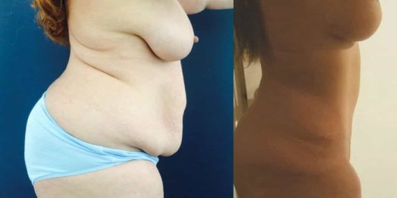 Before and after Mommy Makeover Colombia - Premium Care Plastic Surgery