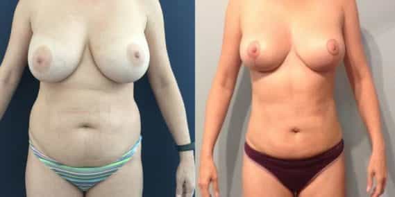 Before and after Mommy Makeover Colombia - Premium Care Plastic Surgery