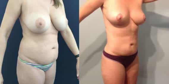 Before and after Mommy Makeover Colombia - Premium Care Plastic Surgery