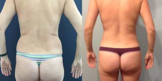 Before and after Mommy Makeover Colombia - Premium Care Plastic Surgery