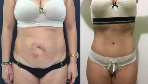 Before and after Mommy Makeover Colombia - Premium Care Plastic Surgery