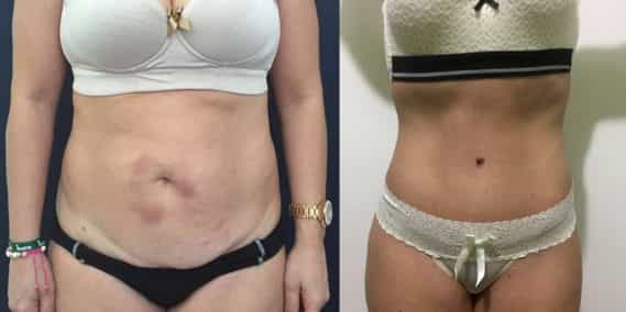 Before and after Mommy Makeover Colombia - Premium Care Plastic Surgery