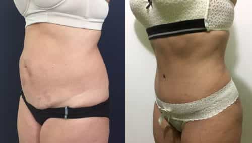 Before and after Mommy Makeover Colombia - Premium Care Plastic Surgery