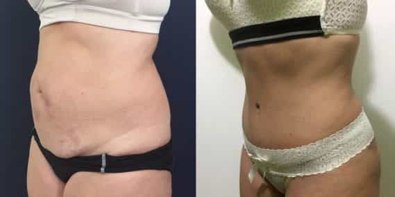Before and after Mommy Makeover Colombia - Premium Care Plastic Surgery