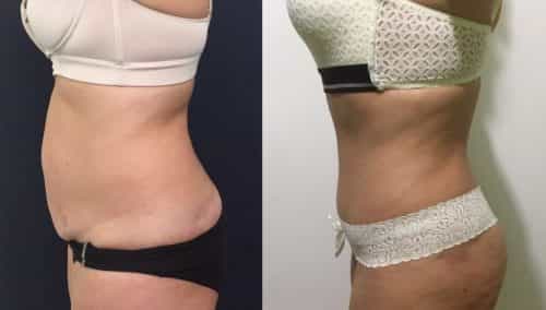 Before and after Mommy Makeover Colombia - Premium Care Plastic Surgery