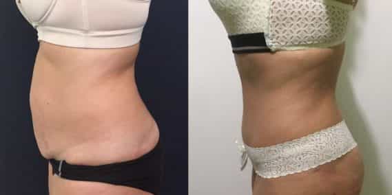 Before and after Mommy Makeover Colombia - Premium Care Plastic Surgery