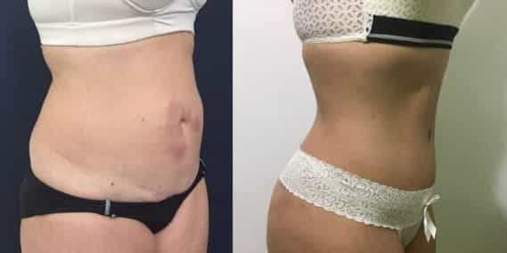 Before and after Mommy Makeover Colombia - Premium Care Plastic Surgery