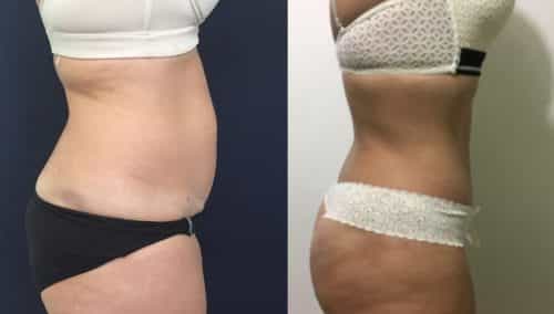 Before and after Mommy Makeover Colombia - Premium Care Plastic Surgery