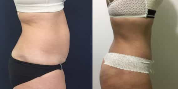 Before and after Mommy Makeover Colombia - Premium Care Plastic Surgery