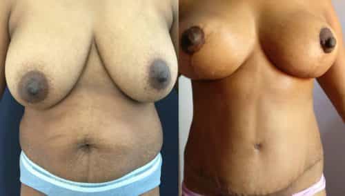 Before and after Mommy Makeover Colombia - Premium Care Plastic Surgery