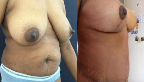 Before and after Mommy Makeover Colombia - Premium Care Plastic Surgery