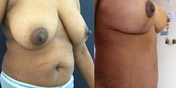 Before and after Mommy Makeover Colombia - Premium Care Plastic Surgery