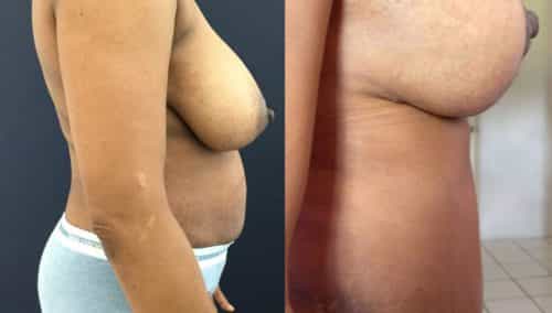 Before and after Mommy Makeover Colombia - Premium Care Plastic Surgery