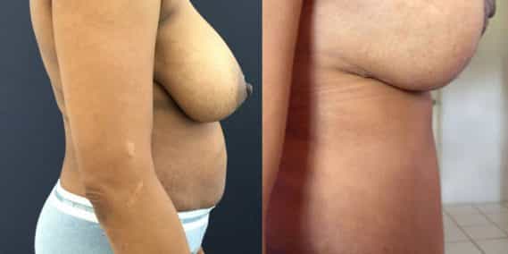 Before and after Mommy Makeover Colombia - Premium Care Plastic Surgery