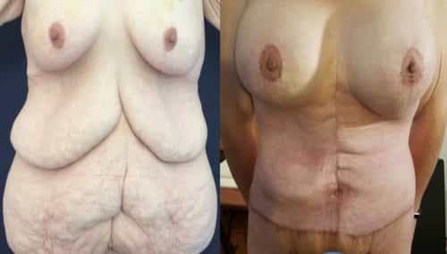 Before and after Mommy Makeover Colombia - Premium Care Plastic Surgery