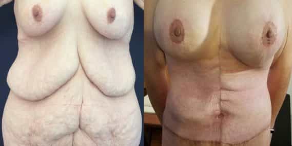 Before and after Mommy Makeover Colombia - Premium Care Plastic Surgery