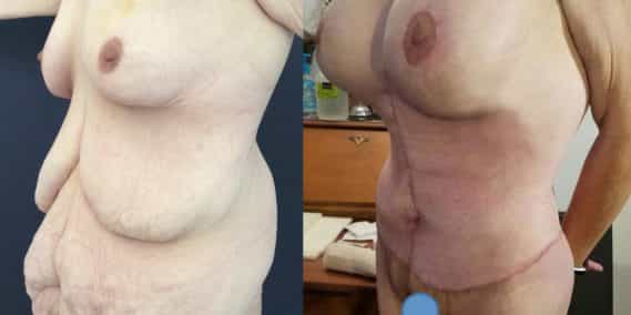 Before and after Mommy Makeover Colombia - Premium Care Plastic Surgery