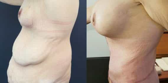 Before and after Mommy Makeover Colombia - Premium Care Plastic Surgery
