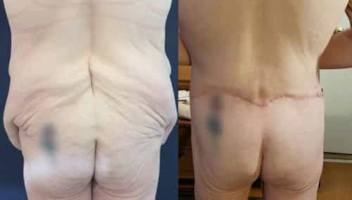 Before and after Mommy Makeover Colombia - Premium Care Plastic Surgery