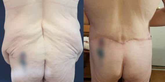 Before and after Mommy Makeover Colombia - Premium Care Plastic Surgery
