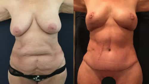 Before and after Mommy Makeover Colombia - Premium Care Plastic Surgery
