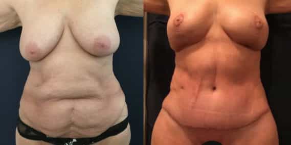 Before and after Mommy Makeover Colombia - Premium Care Plastic Surgery