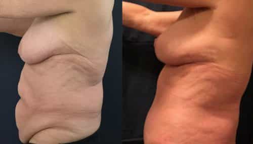 Before and after Mommy Makeover Colombia - Premium Care Plastic Surgery