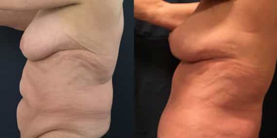 Before and after Mommy Makeover Colombia - Premium Care Plastic Surgery
