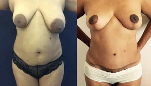 Before and after Mommy Makeover Colombia - Premium Care Plastic Surgery