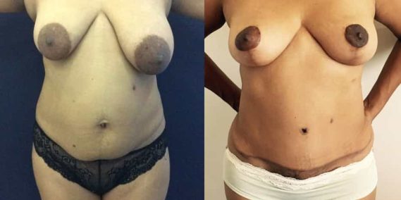 Before and after Mommy Makeover Colombia - Premium Care Plastic Surgery