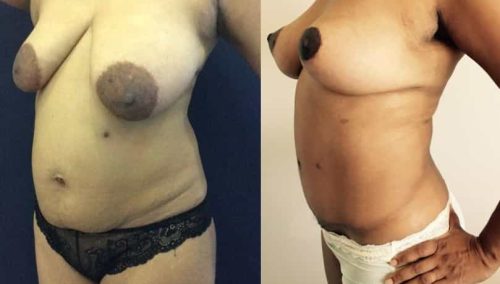 Before and after Mommy Makeover Colombia - Premium Care Plastic Surgery