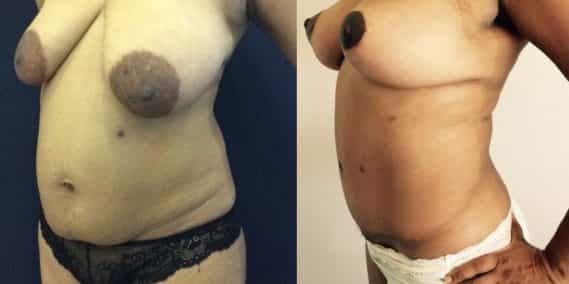 Before and after Mommy Makeover Colombia - Premium Care Plastic Surgery