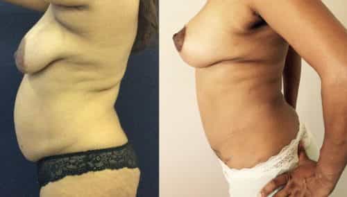 Before and after Mommy Makeover Colombia - Premium Care Plastic Surgery