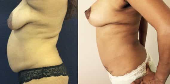 Before and after Mommy Makeover Colombia - Premium Care Plastic Surgery