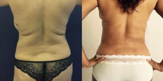 Before and after Mommy Makeover Colombia - Premium Care Plastic Surgery