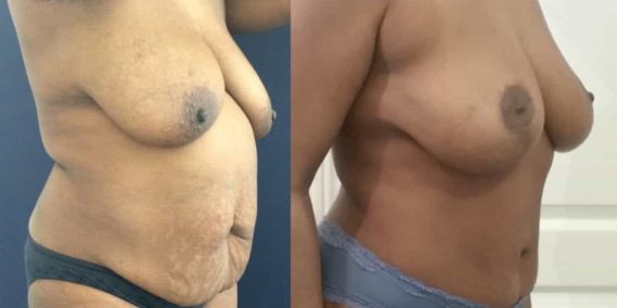 Before and after Mommy Makeover Colombia - Premium Care Plastic Surgery