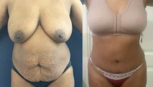 Before and after Mommy Makeover Colombia - Premium Care Plastic Surgery