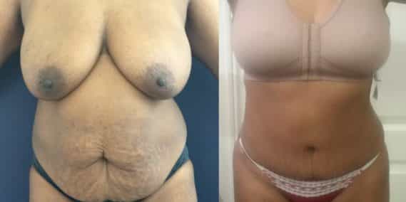Before and after Mommy Makeover Colombia - Premium Care Plastic Surgery