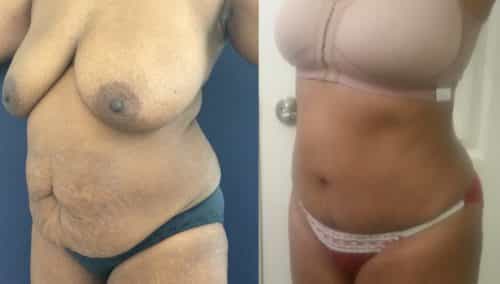Before and after Mommy Makeover Colombia - Premium Care Plastic Surgery