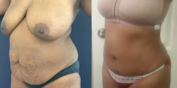 Before and after Mommy Makeover Colombia - Premium Care Plastic Surgery