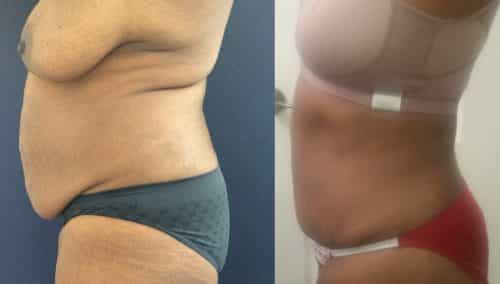Before and after Mommy Makeover Colombia - Premium Care Plastic Surgery