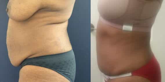 Before and after Mommy Makeover Colombia - Premium Care Plastic Surgery